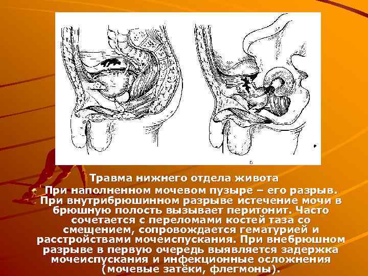 Травма нижнего отдела живота При наполненном мочевом пузыре – его разрыв. При внутрибрюшинном разрыве