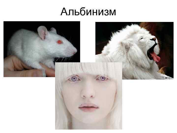 Альбинизм 