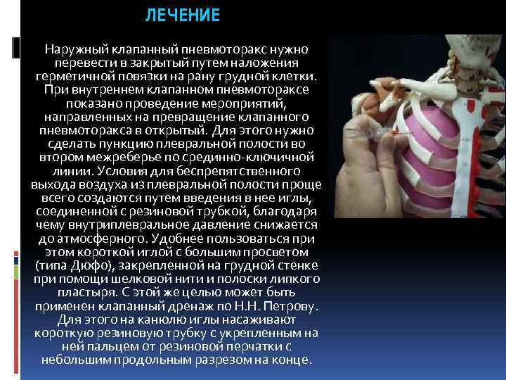 ЛЕЧЕНИЕ Наружный клапанный пневмоторакс нужно перевести в закрытый путем наложения герметичной повязки на рану