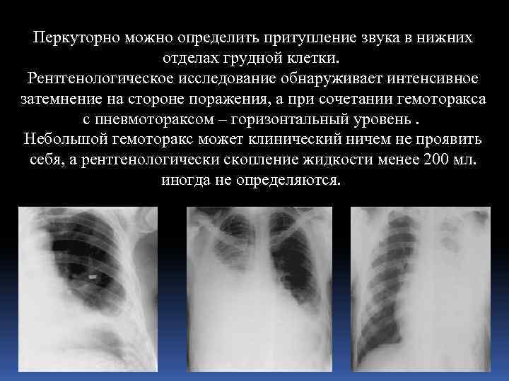 Перкуторно можно определить притупление звука в нижних отделах грудной клетки. Рентгенологическое исследование обнаруживает интенсивное
