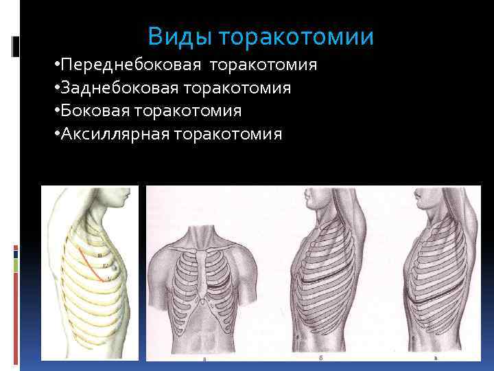  Виды торакотомии • Переднебоковая торакотомия • Заднебоковая торакотомия • Боковая торакотомия • Аксиллярная