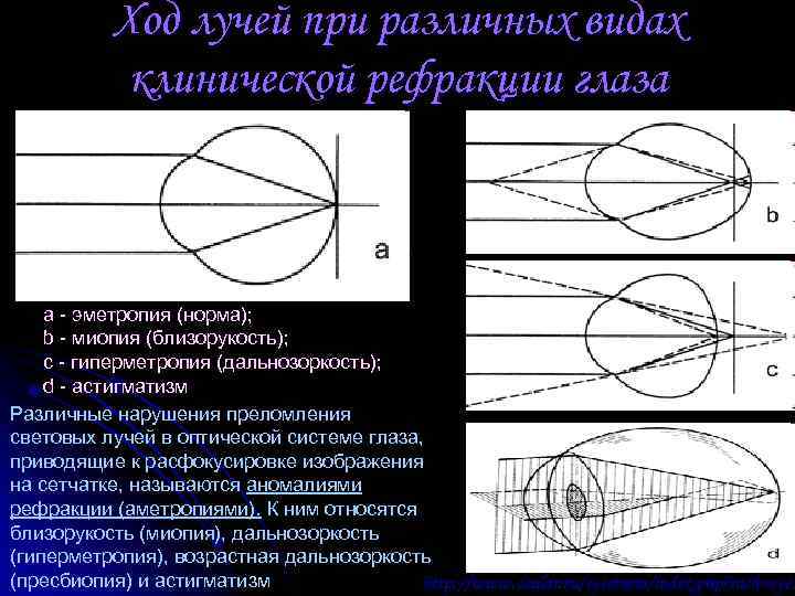 Ход лучей при различных видах клинической рефракции глаза a - эметропия (норма); b -