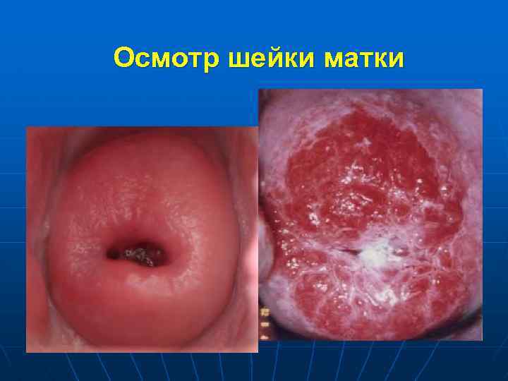 Осмотр шейки матки 