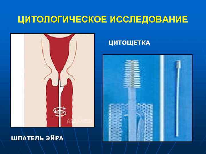 ЦИТОЛОГИЧЕСКОЕ ИССЛЕДОВАНИЕ ЦИТОЩЕТКА ШПАТЕЛЬ ЭЙРА 