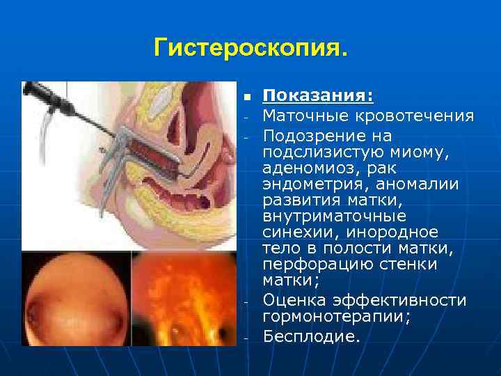 Гистероскопия. n - - Показания: Маточные кровотечения Подозрение на подслизистую миому, аденомиоз, рак эндометрия,