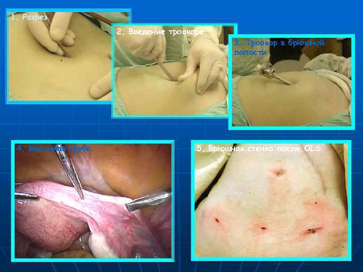 1. Разрез 2. Введение троакара 3. Троакар в брюшной полости 4. Маточная труба 5.