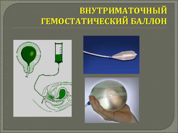 ВНУТРИМАТОЧНЫЙ ГЕМОСТАТИЧЕСКИЙ БАЛЛОН 