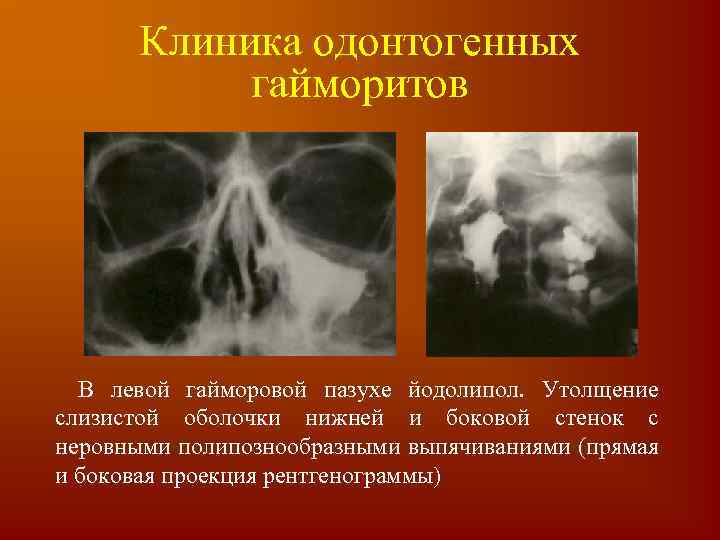 Слизистая оболочка пазухи. Пристеночный гиперпластический верхнечелюстной синусит. Слизистая оболочка левой верхнечелюстной пазухи утолщена. Утолщение слизистой оболочки верхнечелюстных пазух кт. Утолщение слизистой оболочки правой верхнечелюстной пазухи.