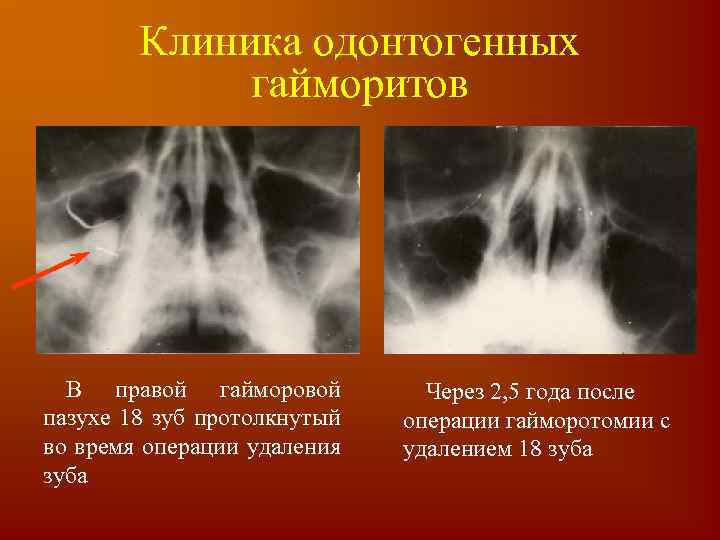 Верхнечелюстной синусит презентация