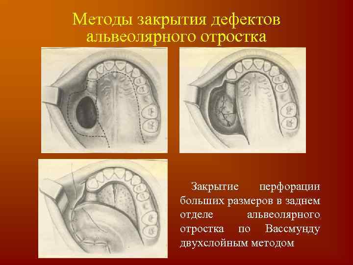 Методы закрытия дефектов альвеолярного отростка Закрытие перфорации больших размеров в заднем отделе альвеолярного отростка