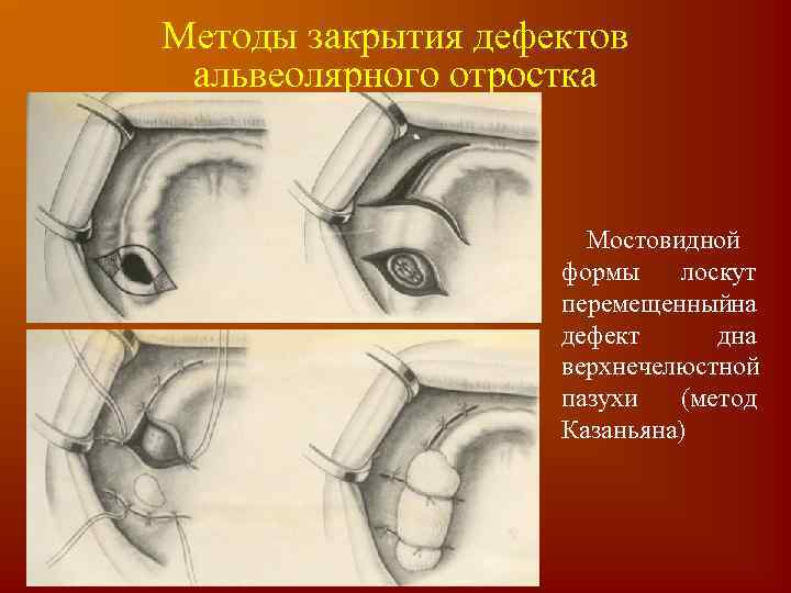 Методы закрытия дефектов альвеолярного отростка Мостовидной формы лоскут перемещенныйна дефект дна верхнечелюстной пазухи (метод