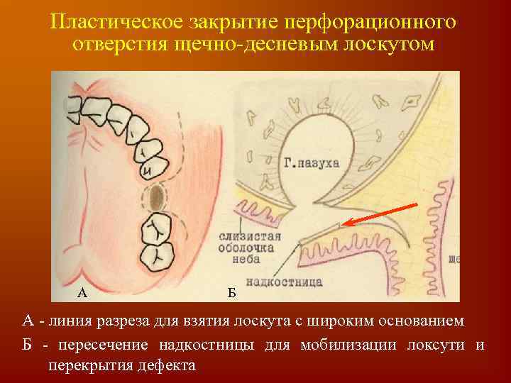 Пластическое закрытие перфорационного отверстия щечно-десневым лоскутом А Б А - линия разреза для взятия