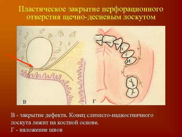 Пластическое закрытие перфорационного отверстия щечно-десневым лоскутом В Г В - закрытие дефекта. Конец слизисто-надкостничного