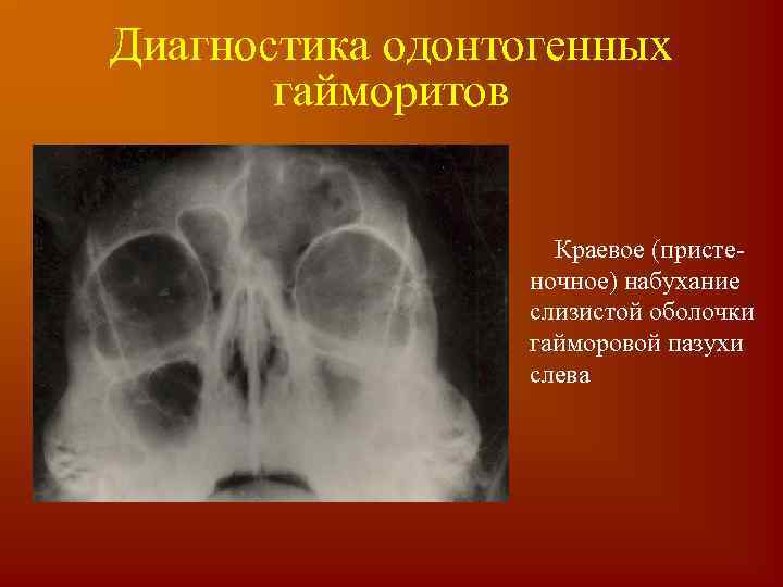 Диагностика одонтогенных гайморитов Краевое (пристеночное) набухание слизистой оболочки гайморовой пазухи слева 