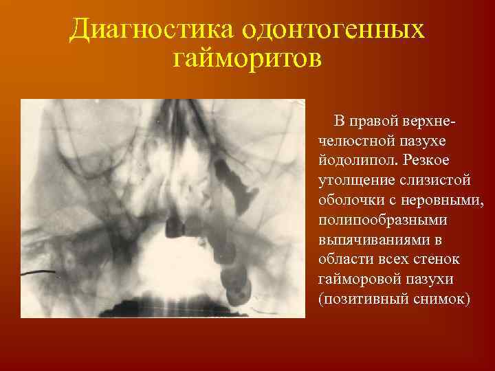 Диагностика одонтогенных гайморитов В правой верхнечелюстной пазухе йодолипол. Резкое утолщение слизистой оболочки с неровными,