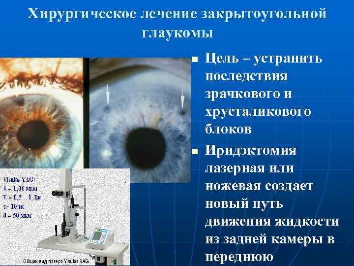 Хирургическое лечение закрытоугольной глаукомы n n Цель – устранить последствия зрачкового и хрусталикового блоков