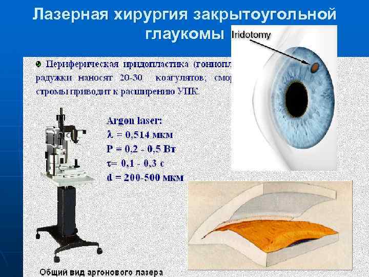 Лазерная хирургия закрытоугольной глаукомы 