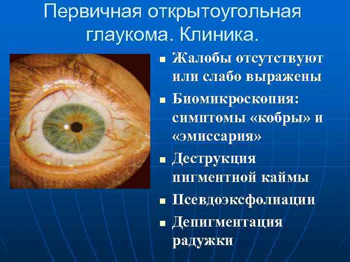 Первичная открытоугольная глаукома. Клиника. n n n Жалобы отсутствуют или слабо выражены Биомикроскопия: симптомы