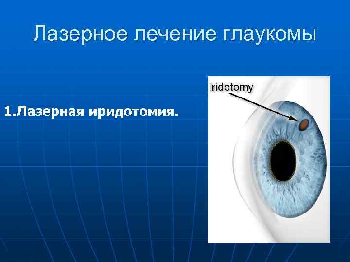Лазерное лечение глаукомы 1. Лазерная иридотомия. 