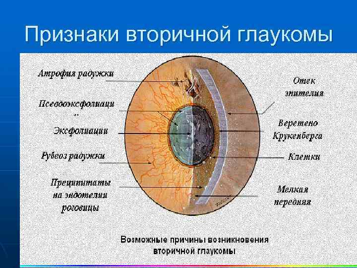Признаки вторичной глаукомы 