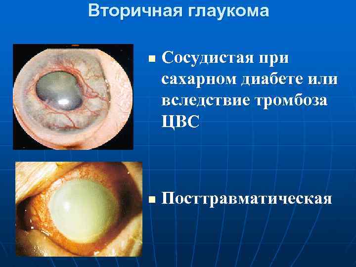 Вторичная глаукома n n Сосудистая при сахарном диабете или вследствие тромбоза ЦВС Посттравматическая 