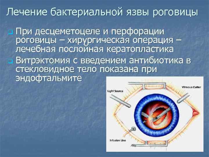 Лечение бактериальной язвы роговицы При десцеметоцеле и перфорации роговицы – хирургическая операция – лечебная