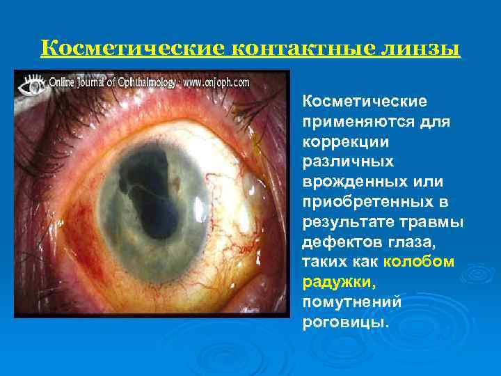Косметические контактные линзы Косметические применяются для коррекции различных врожденных или приобретенных в результате травмы