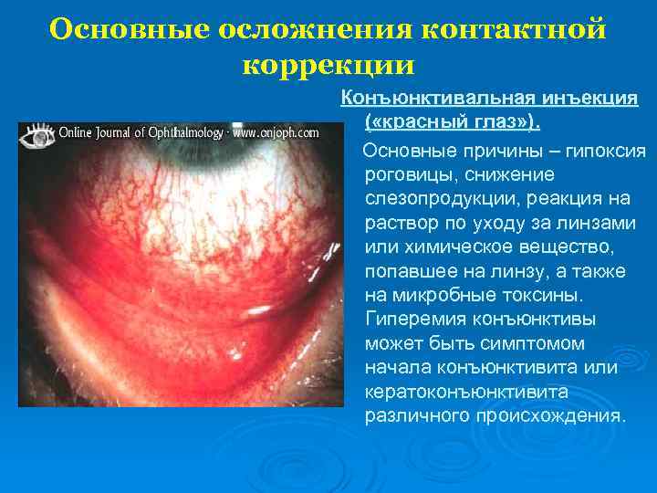 Основные осложнения контактной коррекции Конъюнктивальная инъекция ( «красный глаз» ). Основные причины – гипоксия