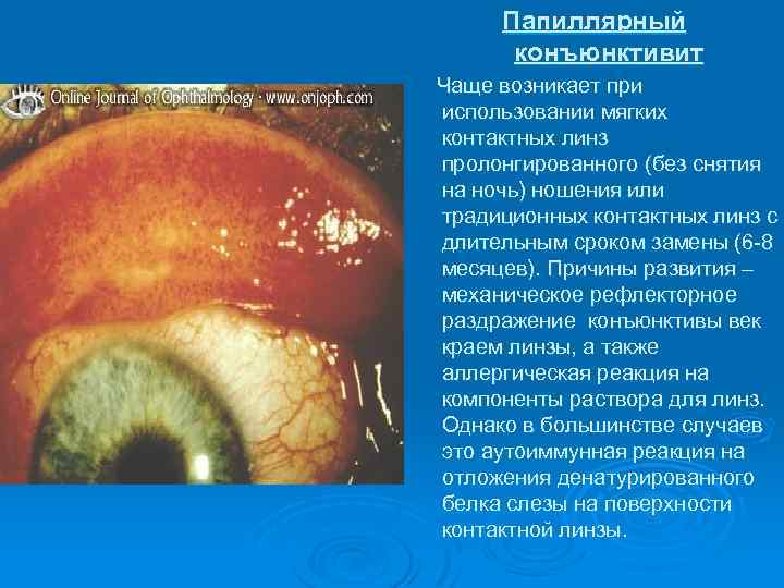 Папиллярный конъюнктивит Чаще возникает при использовании мягких контактных линз пролонгированного (без снятия на ночь)