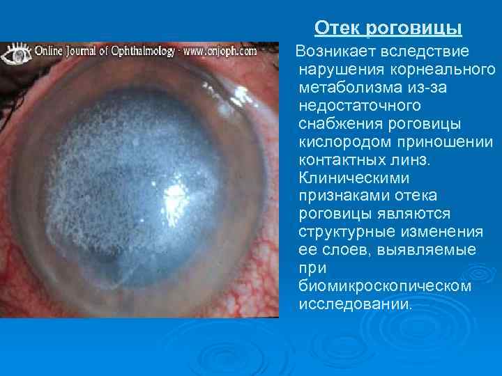 Отек роговицы Возникает вследствие нарушения корнеального метаболизма из-за недостаточного снабжения роговицы кислородом приношении контактных