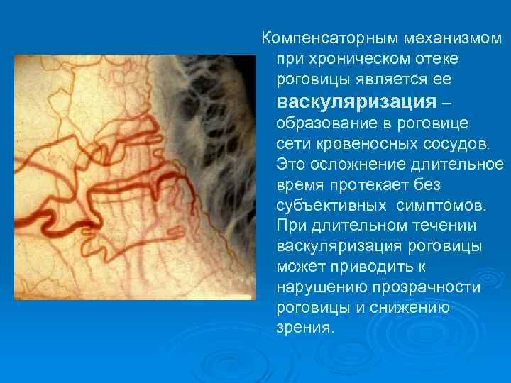  Компенсаторным механизмом при хроническом отеке роговицы является ее васкуляризация – образование в роговице