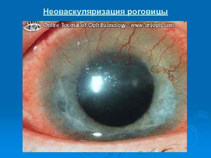 Неоваскуляризация роговицы 