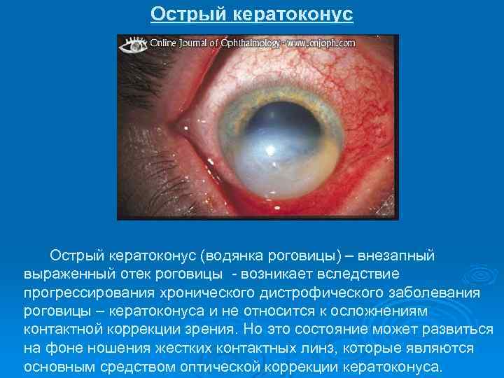 Острый кератоконус (водянка роговицы) – внезапный выраженный отек роговицы - возникает вследствие прогрессирования хронического