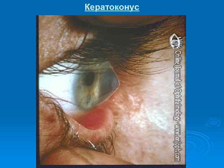 Кератоконус 