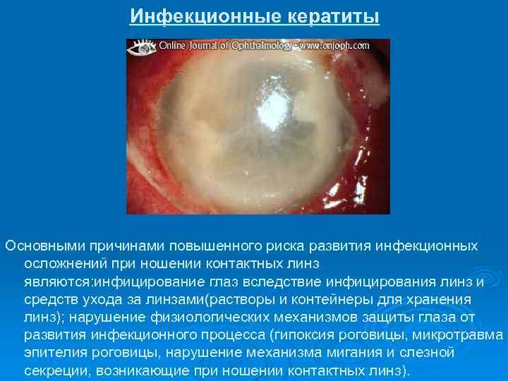 Инфекционные кератиты Основными причинами повышенного риска развития инфекционных осложнений при ношении контактных линз являются:
