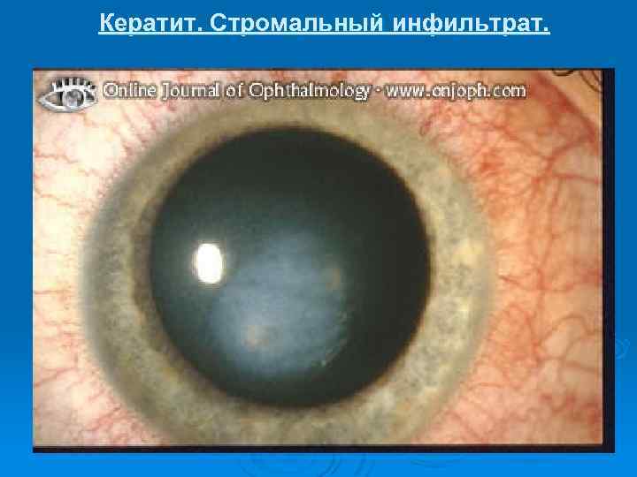 Кератит. Стромальный инфильтрат. 