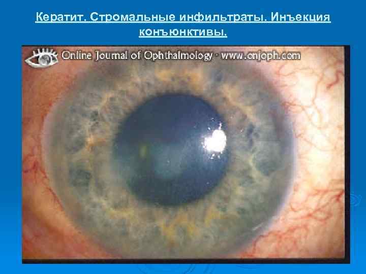 Кератит. Стромальные инфильтраты. Инъекция конъюнктивы. 