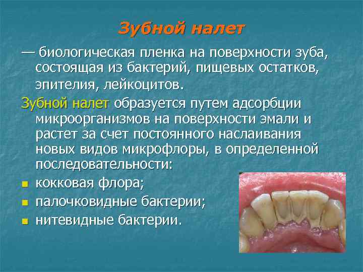 Зубной налет — биологическая пленка на поверхности зуба, состоящая из бактерий, пищевых остатков, эпителия,