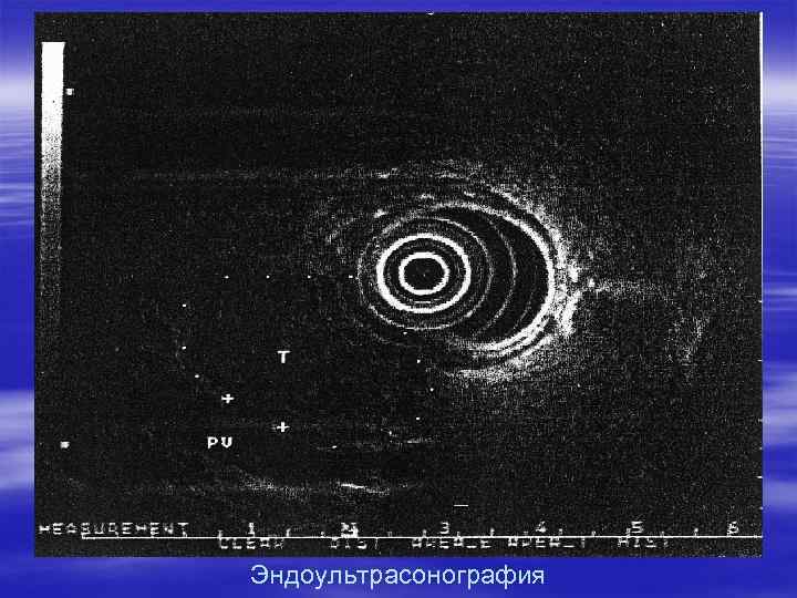 Эндоультрасонография 