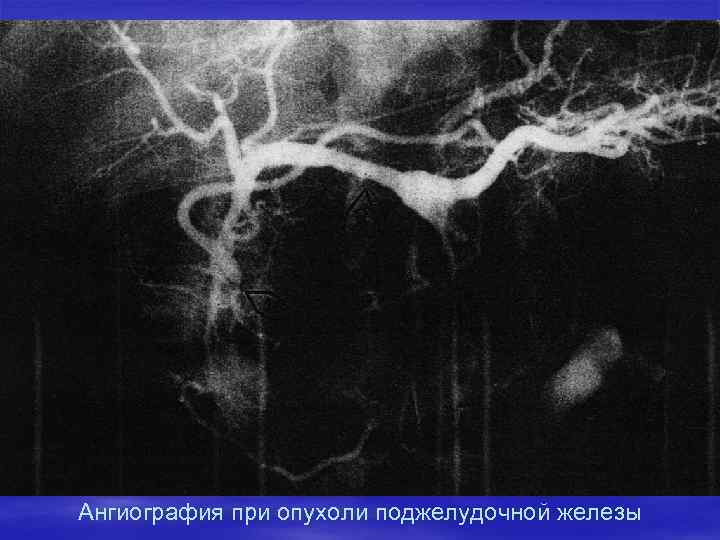 Ангиография при опухоли поджелудочной железы 