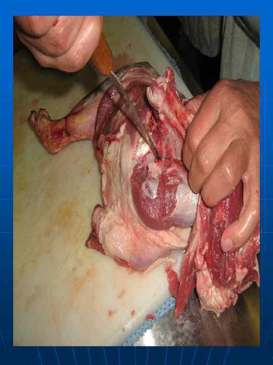 Удаление тазовой кости 