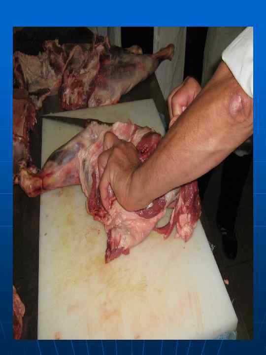 n  Удаление тазовой кости 