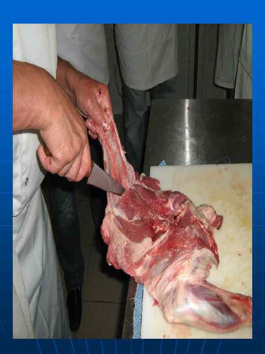 Удаление бедренной и  берцовой костей 