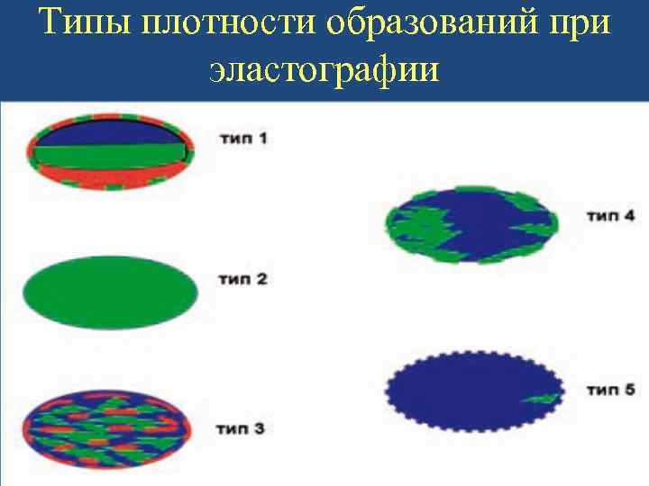 Типы плотности образований при эластографии 