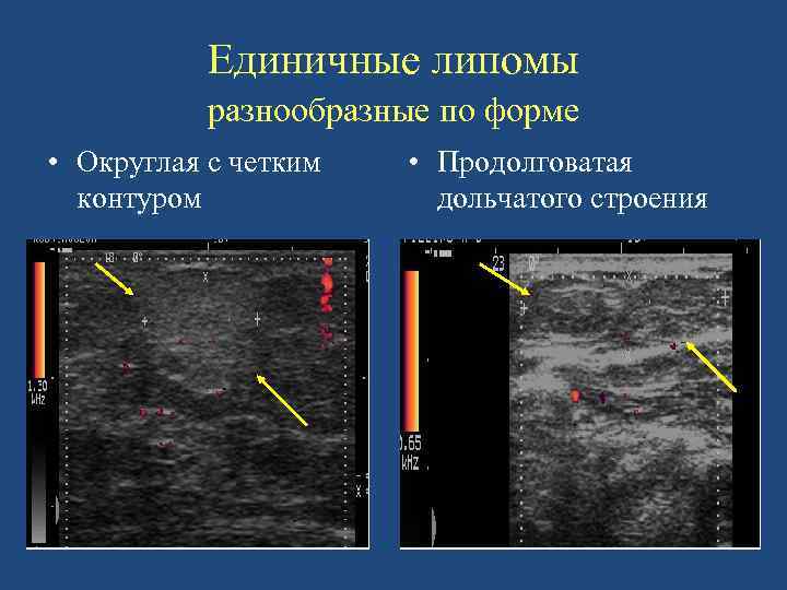 Единичные липомы разнообразные по форме • Округлая с четким контуром • Продолговатая дольчатого строения