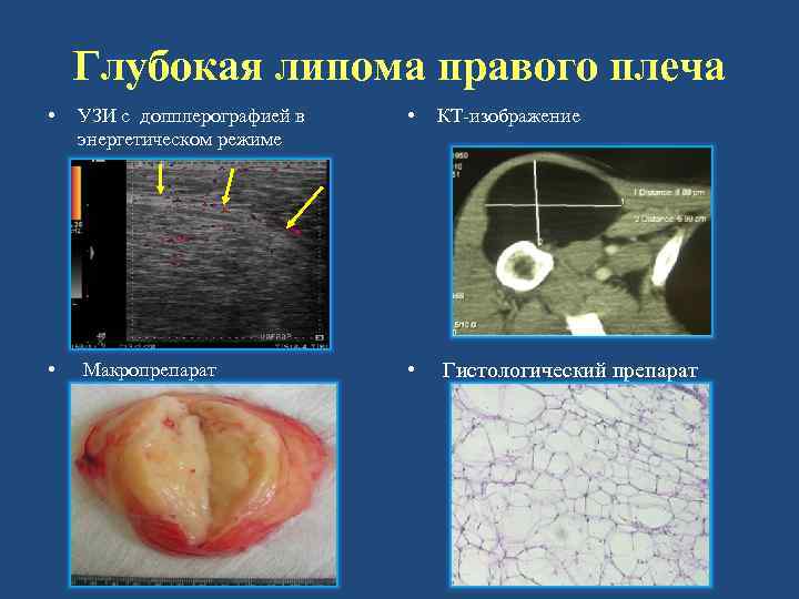 Глубокая липома правого плеча • УЗИ с допплерографией в энергетическом режиме • КТ-изображение •