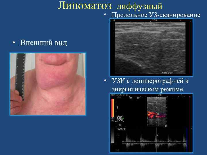 Липоматоз диффузный • Продольное УЗ-сканирование • Внешний вид • УЗИ с допплерографией в энергитическом