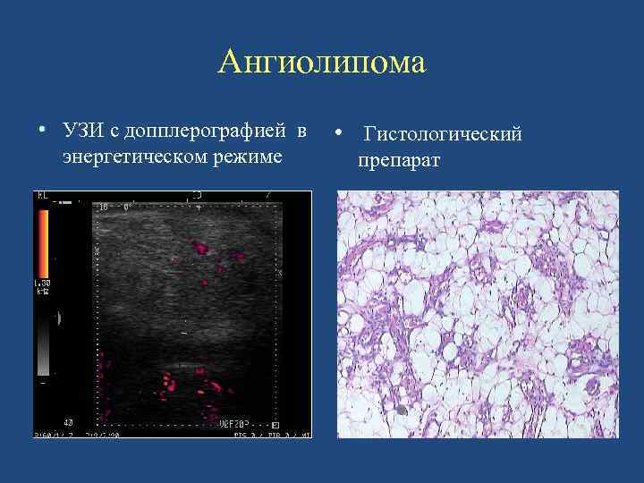 Ангиолипома. Ангиолипома конечности. Ангиолипома УЗИ. Ангиолипома гистология.