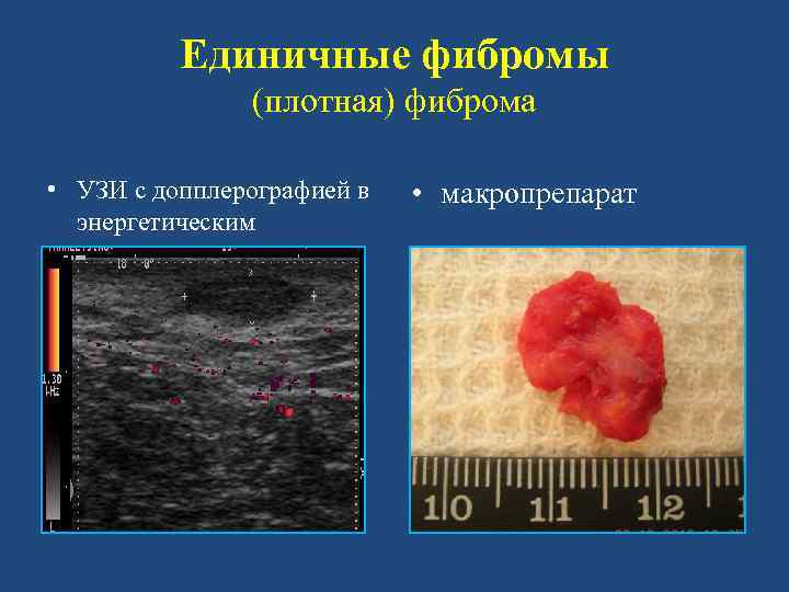Единичные фибромы (плотная) фиброма • УЗИ с допплерографией в энергетическим • макропрепарат 
