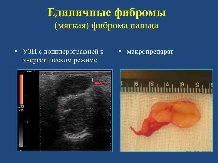 Единичные фибромы (мягкая) фиброма пальца • УЗИ с допплерографией в энергетическом режиме • макропрепарат